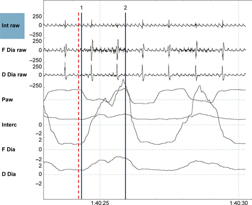 Figure S6 Double triggering.Notes: Shown are (from top to bottom) the raw intercostal signal (Int raw), the raw frontal diaphragm signal (F Dia raw), the raw dorsal diaphragm signal (D Dia raw), the pressure wave (Paw), the average intercostal signal (Interc), the average frontal diaphragm (F Dia) signal, and the average dorsal diaphragm signal (D Dia). A single electromyography wave (dotted red line) is followed by two ventilator delivered breaths (nr.1 and nr.2 straight blue lines).