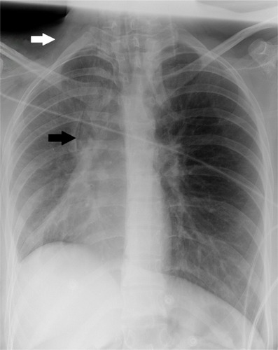 Figure 2 Portable bedside semi-sitting chest radiograph.