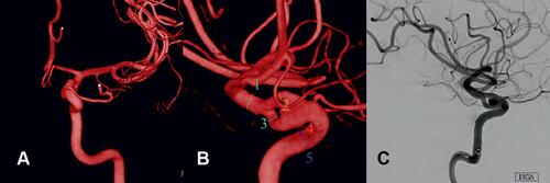 Figure 1 3D-reconstruction (A and B) and lateral view in digital subtraction angiography (C) of left ICA presenting the fenestration with a flow-associated aneurysm within the proximal bifurcation. Vessel lumen diameters in mm as depicted in b: 1–2.77; 2–1.51; 3–1.90; 4–3.73; 5–3.46.