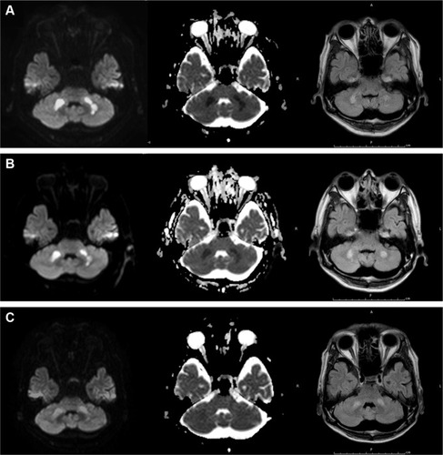 Figure 1 Brain magnetic resonance imaging revealed symmetrical lesions of cerebellum (left, diffusion-weighted imaging; center, apparent diffusion coefficient-map; right, fluid-attenuated inversion recovery) at diagnosis (A), 7 hours (B), and 28 days (C) after the onset of acute necrotizing encephalopathy.