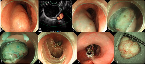 Figure 2. Endoscopic submucosal dissection for a large subepithelial esophageal lesion. (A) Endoscopic view of oval-like tumor. (B) Endoscopic ultrasonography view of the tumor. (C) Submucosal injection with fluid mixture. (D) Incision of the covering mucosa. (E) Peeling the lesions. (F) The wound after resection. (G) Closure of the mucosal incision by clips. (H) The resected specimen.