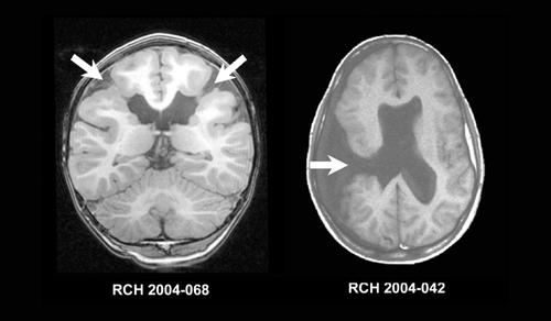 Figure 9. Imaging features of schizencephaly. Coronal T1 - (left) and axial T1 (right)-weighted MRI scans. Both images show full-thickness clefts lined by irregular gray matter (arrows). The image on the left shows bilateral closed-lip schizencephaly (SCZ) and the image on the right shows right open-lipped SCZ and agenesis of the septum pellucidum. MRI, magnetic resonance imaging