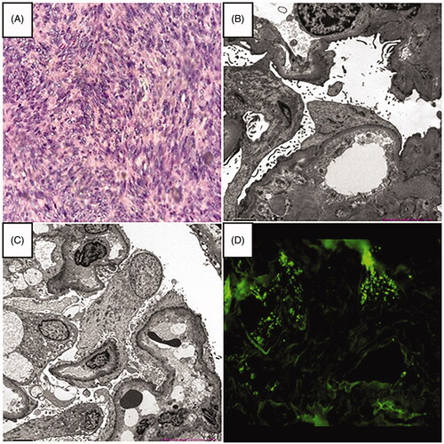 Figure 1. (A) Histological examination of the gastrointestinal stromal tumor (H&E staining × 200). (B, C) Electron microscopy revealed diffuse podocyte foot process effacement, which was considered as podocytopathies (minimal change disease or underlying focal segmental glomerulosclerosis) with acute tubulointerstitial injury (magnification × 2000). (D) Immunofluorescence showing no immune complex deposition (IgG-A-M, C3, C1q).