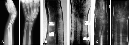 Figure 4. A. Fractures with 50% displacement. B. After reduction, with cast index (a/b) = 0.97, padding index (x/y) = 0.40, and Canterbury index = 0.97 + 0.40 = 1.37. C. After 1 week, showing re-displacement.