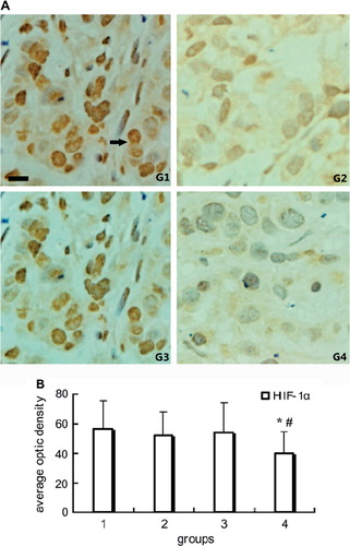 Figure 2. Immunohistochemical staining of HIF-1α in tumor tissue: A. Representative pictures of immunohistochemical staining of HIF-1α in groups. Intense cytoplasmic and nucleus staining of HIF-1α in control. Positive stain of HIF-1α (black arrow). B. Quantitative analysis of average optic density of positive stain in specimen. Note *P < 0.01 compared with control; #P < 0.05 compared with group 2. Scale bar, 25μm for G1-G4.