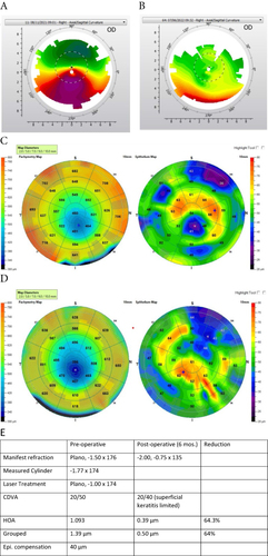 Figure 2 (A–E) Case 2: 32 year old male. (A) Pre-op topography, (B) Post-op topography, (C) Pre-op OCT pachymetry and epithelial thickness map, (D) Post-op OCT pachymetry and epithelial thickness map, (E) patient data.