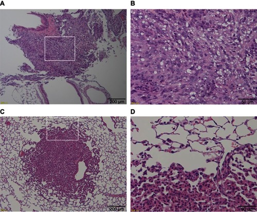 Figure 3 Histological images of two tumor types occurring in the lungs of rasH2 mice. (A) Low power field image of vehicle group in which mesothelioma occurred. A large number of tumor cells with diffused large nuclei were present in the lungs. (B) An enlarged image of (A) surrounded by a white frame. The enlargement of nucleolus and irregular cells were observed, and numerous multinucleated cells were also found that were diagnosed as mesothelioma derived from the pleura. (C) Low power field image of the thin-MWCNTs (high-dose) group in which adenomas occurred. A large nuclear cell was found in a part of the lungs. (D) An enlarged image of (C) surrounded by a white frame. Irregular cells forming gland-like structures were proliferating. MWCNTs were not found in and around the tumor.