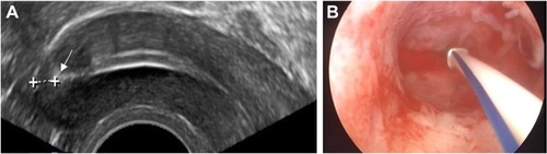 Figure 2 (A) 2D ultrasound of FibroPlant® LNG-IUS in situ. The stainless steel marker or anchor point is shown (arrow). The distance of the anchor point from the serosa is 3.3 mm in this case. The fibrous delivery systems are also clearly visible; (B) hysteroscopic picture of FibroPlant LNG-IUS, implanted in the fundus of the uterus.