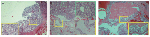 Figure 2. Pathological images of the brother. (A) Clear cell renal cell carcinoma (ccRCC) from the right kidney. The tumor consists of sheet-like, solid clear cells (H&E 40×).The image in the yellow-boxed area displays part (B). Multilocular renal cysts with clear cell renal carcinoma from the right kidney. The yellow-boxed area displays a renal cyst that is lined by a single-layer of clear cells with uniform nuclei (H&E 100×). Additionally, the green-boxed area displays part of the ccRCC with sheet-like, solid clear cells. (C) Cystic renal cell carcinoma from the left kidney. Cysts are lined by clear cells with uniform nuclei. Clusters of clear cells are present in the septal walls (H&E 40×). The image in the yellow-boxed area displays the aggregates of similar-appearing clear cells scattered without permeating the septa and forming solid nodules (H&E 100×).
