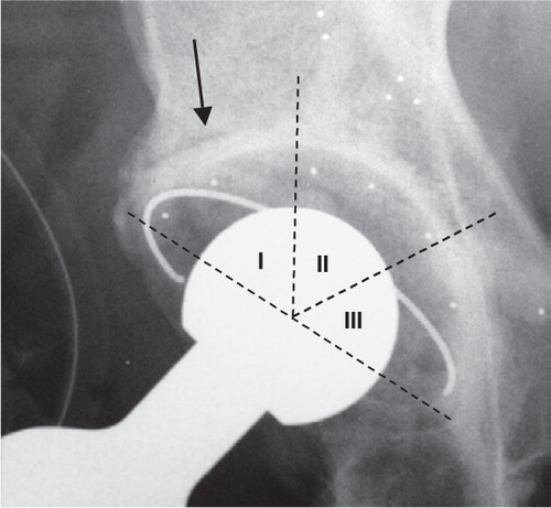 Figure 3. Direct postoperative thin demarcation in zone 1.