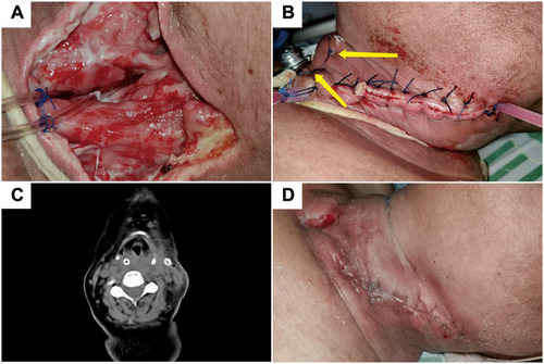 Figure 2 An oxygen tube placed in the pus cavity (A). The pus cavity was sutured and a negative pressure drainage placed in position (B). A re-examination CT image of the neck showing that the pus cavity had disappeared and the swelling of soft tissue had subsided (C). Following removal of the drainage tube the incision healed well (D).