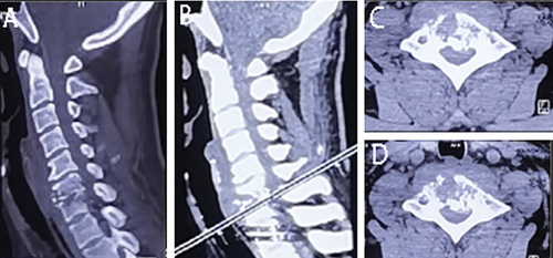 Figure 1 Preoperative CT images at admission. (A and B) Sagittal CT images at admission; (C and D) Axial CT image at admission, C6-7 vertebral body destruction.