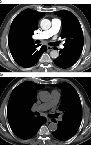 Figure 3.  Axial enhanced CT scan through the right upper lobe of a 79-year-old man (GOLD II) at exacerbation (a) with mild mediastinal lymphadenopathy (arrow) that disappeared at unenhanced control (b).