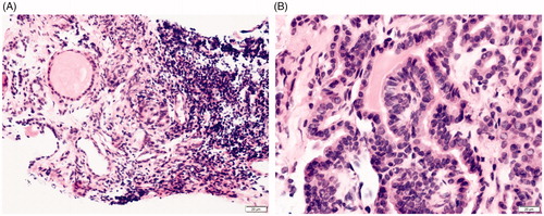 Figure 2. The preoperative and postoperative pathological images of the patient. (A) PTC was diagnosed by preoperative biopsy pathology; (B) degenerative changes were revealed in postoperative biopsy pathology.