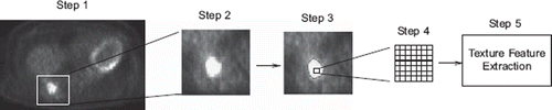 Figure 1. Diagram for Feature Extraction. From left to right: Step 1: Identification of the axial slices showing the tumor. Step 2: Cropping to tumor region and location of the SUVmax. Step 3: Tumor delineation using 40% of the SUVmax. Step 4: Definition of the patch 7×7 voxels in size. Step 5: Feature extraction.