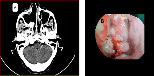 Figure 5 Fourth week post-operative contrast CT of axial para-nasal sinus (A) and Third week post operative nasal endoscopy (B).