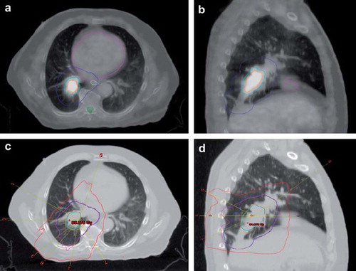 Figure 1. Delineation, beam configuration and isodose curves for case 8, with a. showing a transversal and b. a sagittal view of the tumour on an image blended between the mid-ventilation scan of the 4D-CT and the PET scan. The blue curve is the PTV. The orange curve is 40% of the maximal tumour SUV and adding a 5 mm isotropic margin to this yields PTV-boost represented by the cyan curve. The heart (magenta), the oesophagus (light green) and the spinal canal (green) are close to the target. Part c. shows the transversal and d. the sagittal view with beam configuration and isodose levels. The isocenters of the fields are represented by a yellow line. The plan consisted of four coplanar beams (field number 1–4) and three non-coplanar beams (field number 5–7). The orange isodose curve is 95% of the 82 Gy prescribed to PTV-boost, while the magenta is 95% of 68 Gy (BED2Gy = 66) prescribed to PTV. The red 30 Gy isodose curve shows the conformity of the plan.