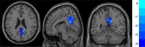 Figure 3 Lower ReHo value in the MDD group: bilateral precuneus, posterior cingulate cortex, and middle cingulate cortex.