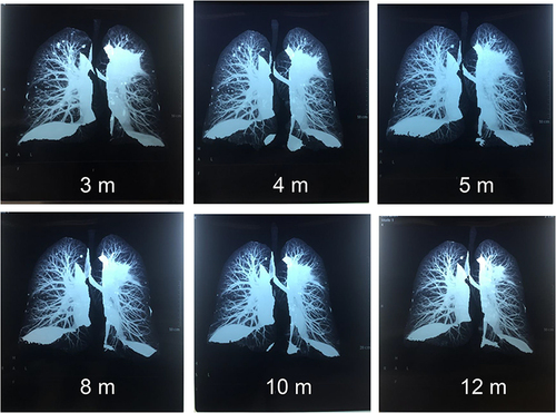 Figure 3 Three-dimensional CT Reconstruction of the Lungs. The consolidation in the left upper lung lobe and the multiple lung nodules gradually disappeared. CT was obtained on month 3 after the first admission. m, months.