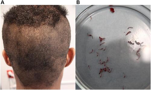Figure 13 Posterior view of patient 10 after shaving with a guardless caliber shows a discernible hair flow direction but with varying synchronized directions (A). His grafts show a mix of straight and gently curved grafts (B).