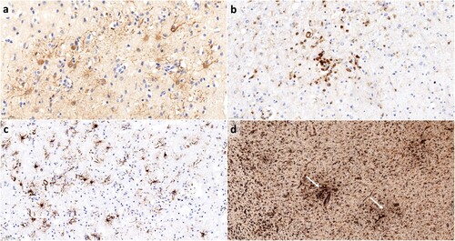 Figure 1. Examples for the immunohistochemical stains. (a) shows Bo18 immunohistochemistry for BoDV-1 nucleoprotein with Bo18-positive astrocytes (scale bar: 50 μm). In (b), an example of CD45 immunohistochemistry for lymphocytes is given (scale bar: 50 μm). (c) shows GFAP-positive reactive astrocytes (scale bar: 50 μm). In (d), microglial activation is demonstrated by Iba1 immunohistochemistry. Note the formation of microglial nodules (white arrows; scale bar: 200 μm).