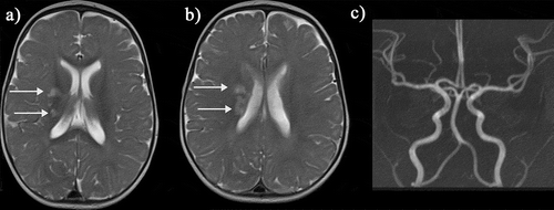 Figure 3. Basal ganglia infarct: This young child who is a compound heterozygote had a left hemiparesis at the age of six months, before transcranial Doppler screening was mandated. Prior to that, the child had had a cold on and off for the last few months and tended to breathe rather heavily and to snore on and off. (a,b) The T2-weighted magnetic resonance imaging showed patchy hyperintensity within the right superomedial striato-capsular region, with associated diffusion restriction (not shown), consistent with acute evolving infarction. (c) Magnetic resonance angiography was normal, as was imaging transcranial Doppler but patent foramen ovale was demonstrated on bubble contrast echocardiography although venography of the legs and pelvis did not demonstrate clot. Treatment was with aspirin as well as regular blood transfusion