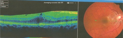 Figure 5 Optical coherence tomography done 1 year before presentation revealed a diffuse epiretinal membrane being thin temporal to the fovea and very thick nasal to the fovea (epicenter) with marked thickening of the central fovea.