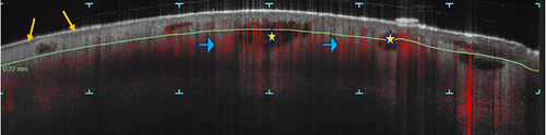 Figure 3 D-OCT (dynamic OCT) capture of discoid eczema lesion. Multiple vesicles (yellow stars); acanthosis; elongated capillaries in a psoriasiform pattern (blue arrows); areas of hyperkeratosis (Orange arrows).