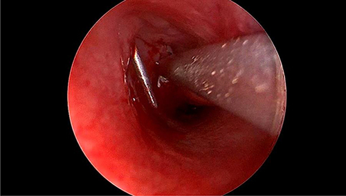 Figure 1 Endoscopic-assisted probing.