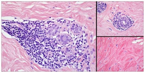 Figure 2 Breast biopsy showing lymphocytic mastitis consistent with diabetic mastopathy. Hematoxylin-eosin stains: Left, original magnification 400×; right top, original magnification 400×; right bottom, original magnification 400×.