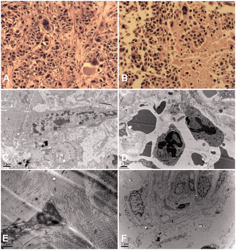 Figure 2. The morphologic and ultrastructure of pleural tumour tissue before and immediately after IPHC. (A) Tumour specimen before IPHC showed piles of tumour cells (200 ×); (B) The same tumour specimen after IPHC exhibited extensive necrosis (200 ×); (C) Pleural carcinomatous nodules found large and irregular nucleus before IPHC by electron microscopic; (D) The chromatin began to concentrate accompanied with apoptotic body after IPHC; (E and F) Normal pleural tissues showed no ultrastructure change by electron microscopy before and after IPHC. IPHC intrapleural perfusion with hyperthermic chemotherapy.