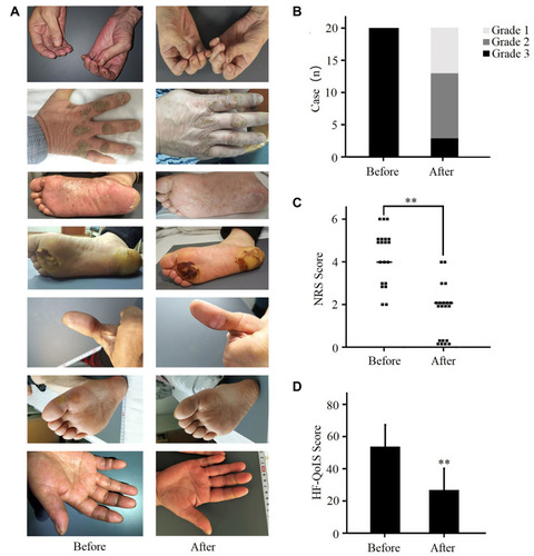Figure 2 Evaluation of MKIs-associated HFSR through NCI (National Cancer Institute) grades, NRS score, and HF-QoLS score, respectively. (A) Representative photos of hands and feet of the twenty patients. Before the SND treatment: shown in the left panels; after the SND treatmnet: shown in the right panels. (B) Grading of HFSR before and after the SND treatment. (C) NRS score before and after the SND treatment. (D) HF-QoLS score before and after the SND treatment. **P <0.01.