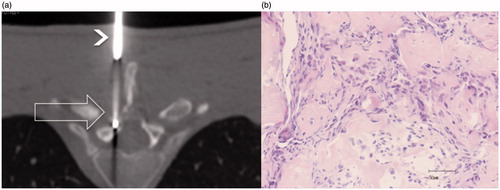 Figure 1. (a) CT axial slice (low resolution due to the low dose used with Fluoro-CT to reduce the dose), RFA needle inside the lesion (large unfilled arrow), and the bone biopsy needle (arrowhead) used as a guide; (b) core biopsy histology revealing disorganised trabeculae of immature bone consistent with OB (haematoxylin–eosin).
