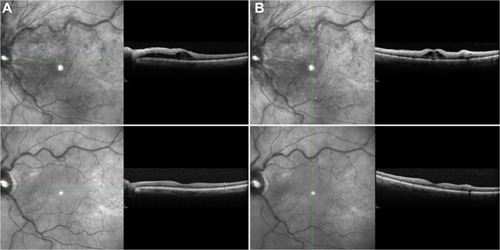 Figure 2 Horizontal (A) and vertical (B) scans of eye at presentation showing subretinal fluid extending from the optic disc to the fovea. Corresponding follow-up scans (lower panels) 5 months after treatment showing complete resolution of subretinal fluid.