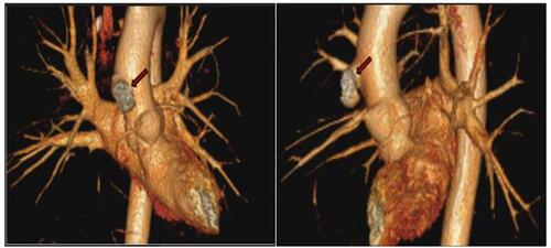Figure 2 3-D CT angiogram of the aorta and its major branches, with arrow pointing towards the pseudoaneurysm.