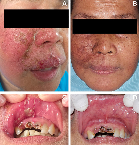 Figure 5 A 63-year-old woman with PHN. (A) Dry crusts on the right portion of the face, preceded by multiple vesicles with an erythematous area (picture taken by the patient). (B) The condition on the first visit: extraoral findings showed multiple blackish-brown patches. (C) Intraoral findings showed multiple ulcers on the right portion of labial mucosa (picture taken by the patient). (D)The condition on the first visit: intraoral findings showed no lesion.