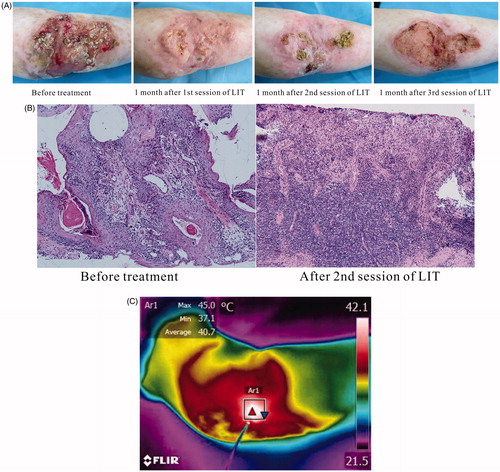 Figure 7. Laser immunotherapy with optimal thermal effects for the patient with refractory cutaneous squamous cell carcinoma (cSCC) in clinic. (A) Representative photographs of a patient with cSSC before and after laser immunotherapy treatments. (B) Histopathology of the patient before and after two sessions of laser immunotherapy treatments at 100×. (C) A thermographic image of the patient being treated by laser.