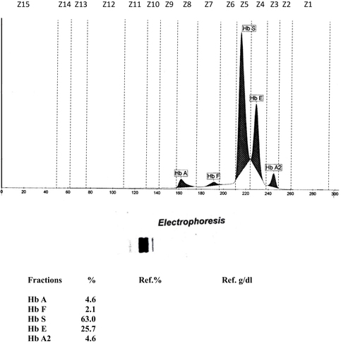 Figure 1 Hb-electrophoresis chromatogram of Case 1 shows the presence of the Hb variant suggestive of Hb S and Hb E with their percentage.