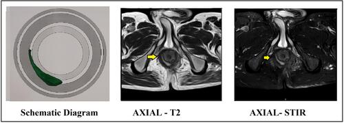 Figure 5 Abscess in right intersphincteric space from 9 to 6 o’clock. (external sphincter muscle can be seen lateral to the abscess). Abscess indicated by yellow arrows. Left panel: Schematic diagram. Middle panel: MRI axial section T-2 sequence. Right panel: MRI axial section STIR sequence.