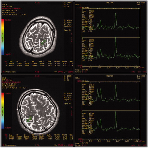 Figure 3. Magnetic resonance spectroscopy imaging (MRSI) spectrum from a patient presented with predominantly left upper limb weakness. A 35-year-old man developed progressive weakness of the left arm for 10 months. Neurological examinations revealed profound weakness and atrophy in the left arm, mild weakness with spasticity in the right arm and the tongue, and increased tendon reflexes with abnormal plantar extensor responses in bilateral lower limbs. Electrophysiological examinations demonstrated widespread denervation and reinnervation consistent with a clinical diagnosis of definite amyotrophic lateral sclerosis (ALS). MRSI scan revealed an N-acetyl aspartate–creatine (NAA/Cr) ratio of 2.36 (region of interest 5, upper row) in the left hand motor cortex (the less affected hemisphere) and an NAA/Cr ratio of 1.23 (region of interest 3, lower row) in the right side (the most affected hemisphere), which was in accordance with clinical findings.