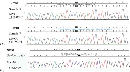Figure 4. (A)Sanger sequencing results of samples 5 and 7. The loci of the mutation c.1109C>T are the nucleotides with a black background. Compared with the reference sequence of NCBI sample 7 carried the MYOC mutation c.1109C>T, while sample 5 did not. (B) Sanger sequencing result of the newborn baby (from sample 5). Compared with the reference sequence of NCBI the newborn baby did not carry the MYOC mutation c.1109C>T. This result is the same as in sample 5.