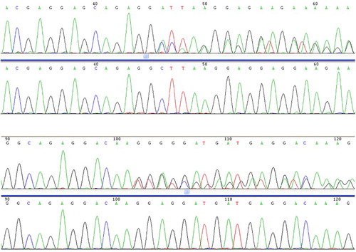 Figure 1. The two types of CALR mutations identified in this study. L367fs*46 (52 nucleotide deletion) and K385fs*47 (TTGTC insertion).