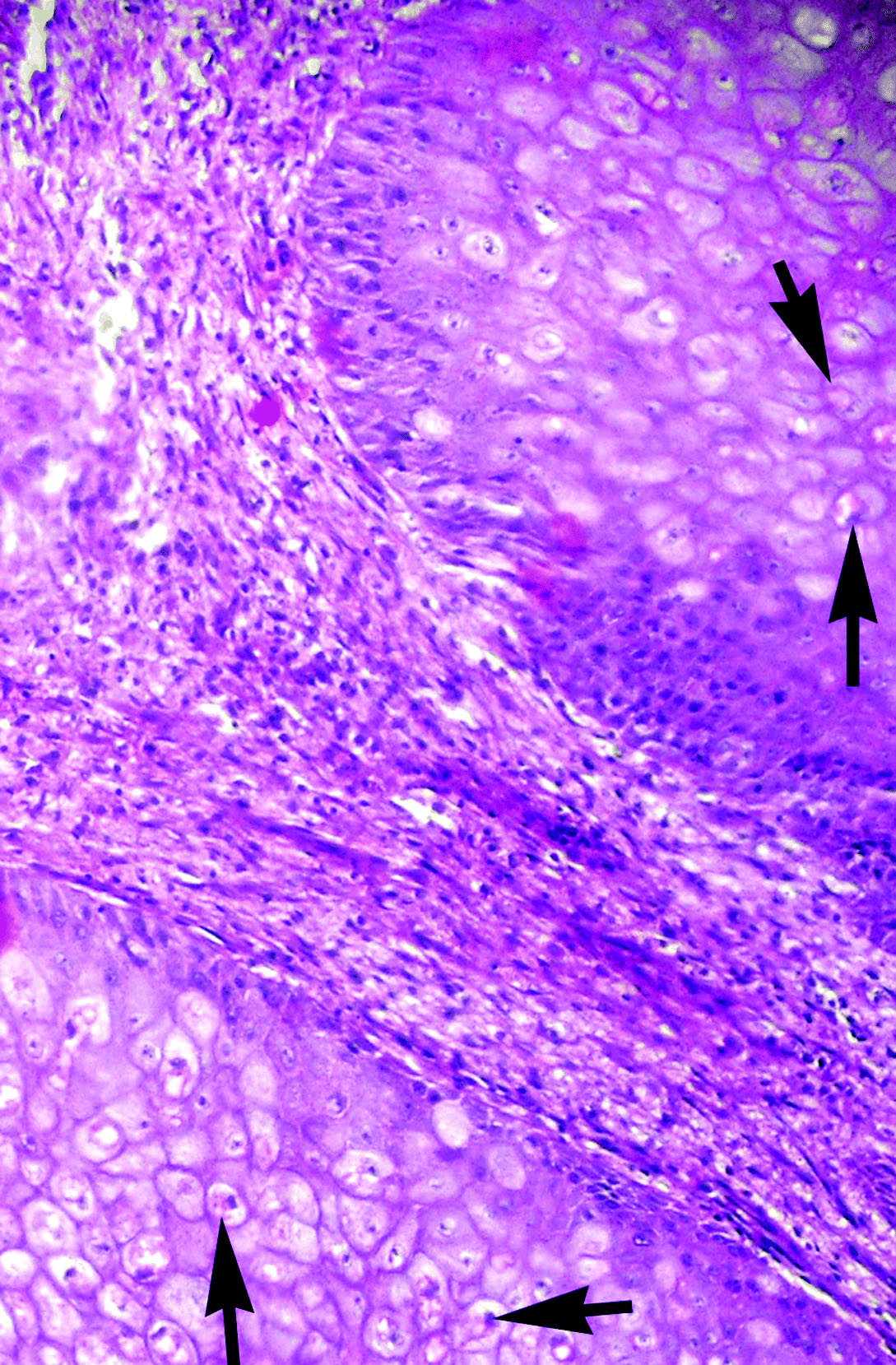 Figure 5.  Extensive proliferation of fibrous connective tissue, rounded and swollen keratinocytes with pleomorphic and hyperchromatic nucleus and eosinophilic intracytoplasmic (Bollinger bodies) inclusion bodies (arrows) in peafowl chick suffered from avian pox. Haematoxylin and eosin. Magnification x100.