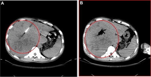Figure 3 CT scan guiding of the tip of the needle into the tumor and density changes during (A) after (B) intratumoral injection.