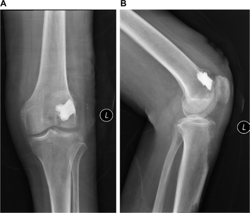 Figure 3 (A) Posteroanterior radiograph; (B) lateral radiograph showing the distribution of cement after percutaneous cementoplasty.