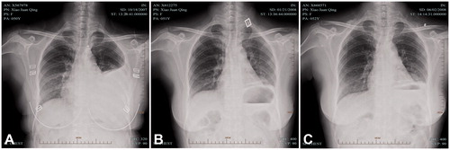 Figure 4. A case of a 50-year-old female with MPE from lung adenocarcinoma received IPHC. (A) A posteroanterior chest radiograph showed a large pleural effusion before treatment; (B) No residual fluid was seen on the chest radiograph 3 months after IPHC; (C) No effusion in the chest was confirmed 10 months after IPHC. IPHC intrapleural perfusion with hyperthermic chemotherapy.