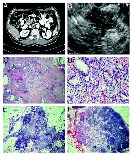 Figure 1. Radiographic and pathological features of pancreatic adenocarcinoma with metastasis to regional lymph nodes. (A) computed tomograph showing heterogeneous attenuation in the head and neck region of the pancreas (green arrow) with abrupt termination of common bile duct and pancreatic duct consistent with pancreatic cancer. (B) endoscopic ultrasonograph showing a large, hypoechoic mass (indicated diagonally by yellow and blue dotted lines) in the head of the pancreas with irregular outer margins. (C–F) histology of resected pancreatic adenocarcinoma stained with hematoxylin and eosin. (C) pancreatic tumor that contains atypical glands infiltrating a markedly desmoplastic stroma consistent with well-differentiated adenocarcinoma (20x magnification). (D) pancreatic adeno-carcinoma, in which atypical glandular epithelia contain large, pleomorphic nuclei with prominent nucleoli (200x magnification). (E and F) peri-pancreatic lymph nodes containing metastatic adenocarcinoma (20x magnification).