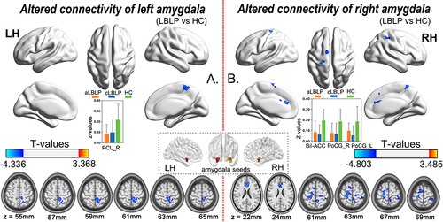 Figure 1 Altered connectivity of the left (A) and right (B) amygdala in LBLP patients (voxel-level P < 0.01, GRF correction at cluster-level P < 0.05).