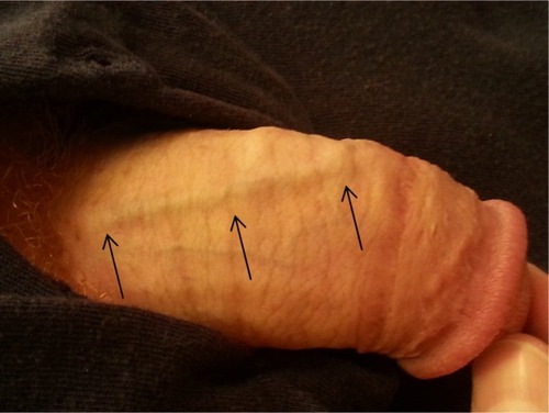 Figure 1 Photo of penis demonstrating slightly raised dorsal vein (arrows) without any overlaying erythema or other remarkable PE findings.