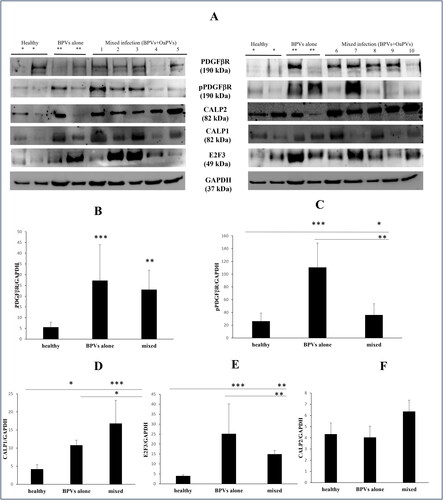 Figure 3. (A) WB analysis performed on healthy and pathological bladders of total and phosphorylated PDGFβR, E2F3, calpain 1 and calpain 2. *Expression of proteins in healthy bladders as control; **expression in bladders infected by BPVs only; lines signed by 1–10: expression in bladders tumors infected both by BPVs and OaPVs. (B–C) Significant overexpression of total and phosphorylated PDGFβR in infected bladders as shown by densitometric analysis. (D) Significant overexpression of calpain 1 in infected bladders as shown by densitometric analysis. (E) Significant overexpression of E2F3 in infected bladders as shown by densitometric analysis. (F) Densitometric analysis showed no significant variation of calpain 2 expression in pathological bladders compared to healthy bladders.